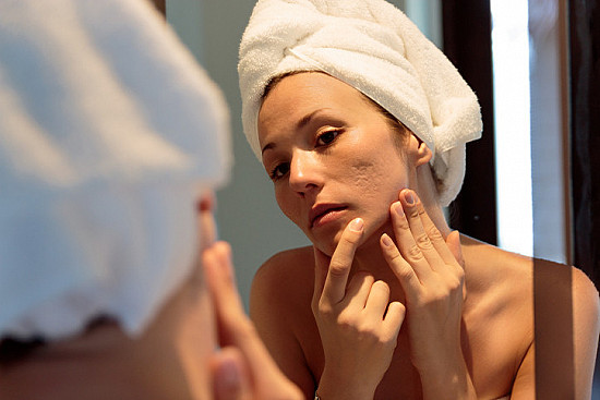 5 Langkah-langkah Menghilangkan Acne Secara Permanen 5 Langkah-langkah Menghilangkan Acne Secara Permanen