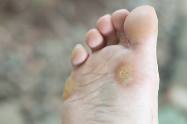 5 Cara Alami Mengatasi Kapalan dan Kulit Kaki Tebal