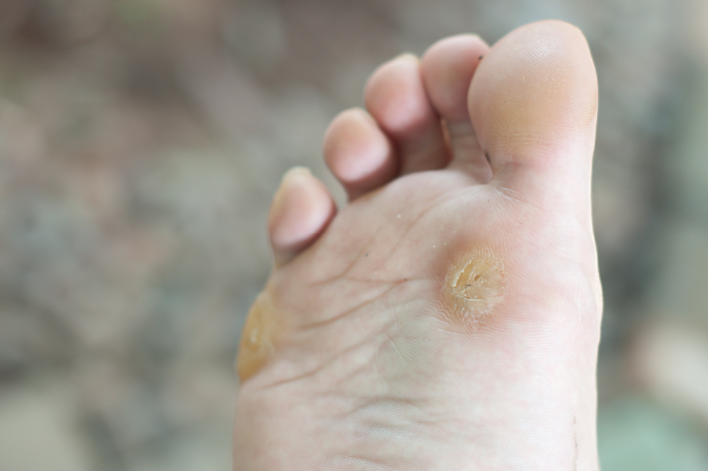 5 Cara Alami Mengatasi Kapalan dan Kulit Kaki Tebal