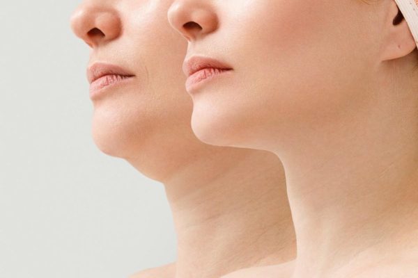 7 Cara Merawat Dagu agar Tidak Terlihat Kendur
