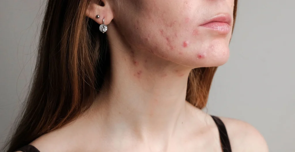 5 Cara Membedakan Jerawat Hormonal dan Jerawat Biasa