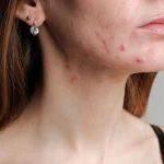 5 Cara Membedakan Jerawat Hormonal dan Jerawat Biasa