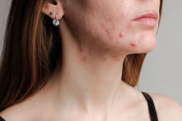 5 Cara Membedakan Jerawat Hormonal dan Jerawat Biasa
